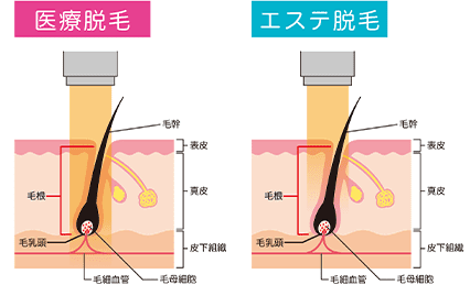 医療脱毛とエステ脱毛の違い