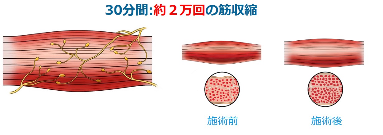 エムスカルプトの構造